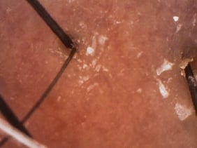 赤い頭皮 全体的に赤い