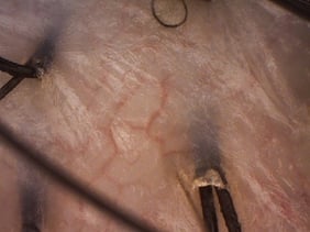 赤い頭皮 血管が透ける