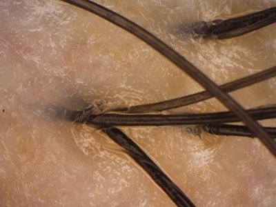 頭皮 夏 べたつき