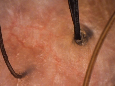 頭皮 春 赤み 炎症 べたつき